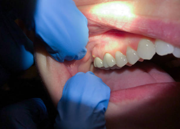 Best Emergency Dentist for Lost Fillings or Crowns in Balfour, NC